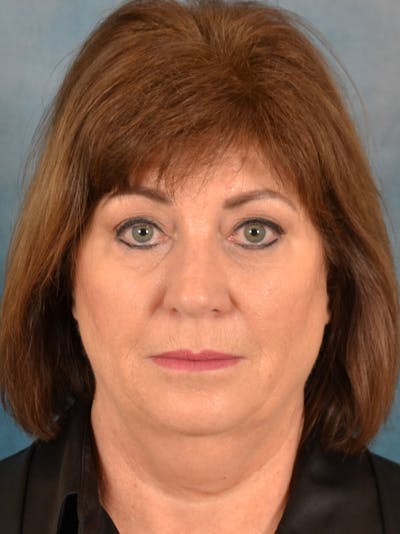 Laser Skin Resurfacing Before & After Gallery - Patient 215445 - Image 1