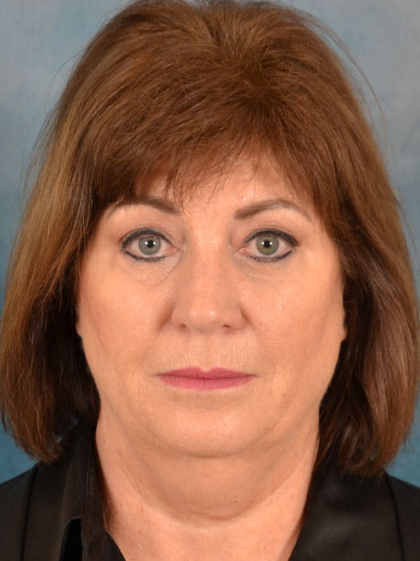 Laser Skin Resurfacing Before & After Gallery - Patient 215445 - Image 1