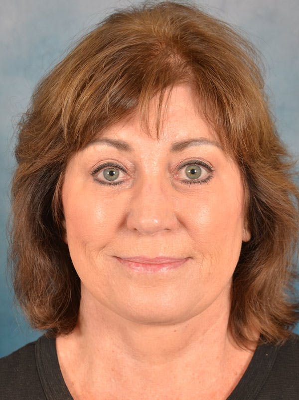 Laser Skin Resurfacing Before & After Gallery - Patient 215445 - Image 2