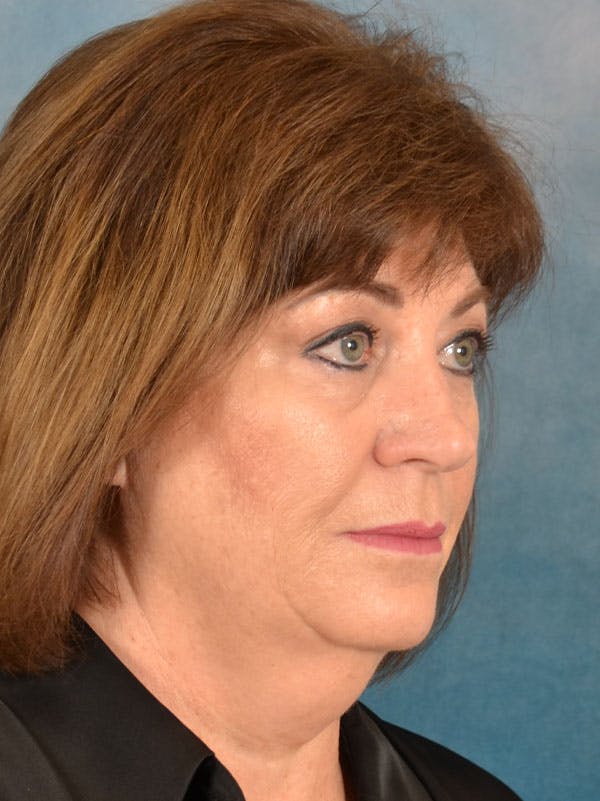 Laser Skin Resurfacing Before & After Gallery - Patient 215445 - Image 9