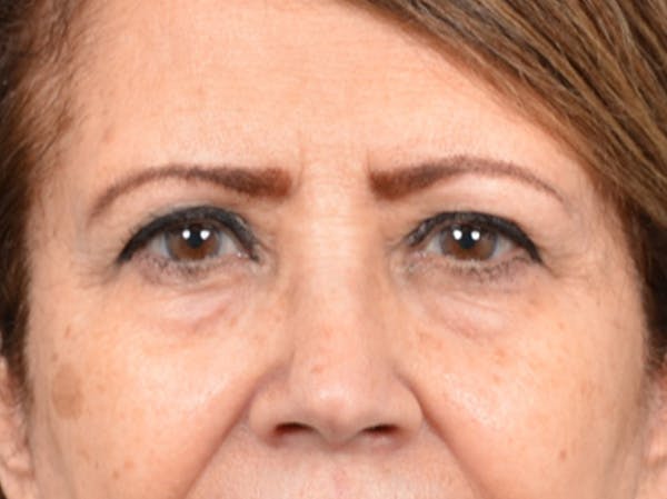Brow Lift Before & After Gallery - Patient 109629 - Image 1