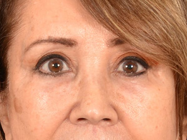 Brow Lift Before & After Gallery - Patient 109629 - Image 2