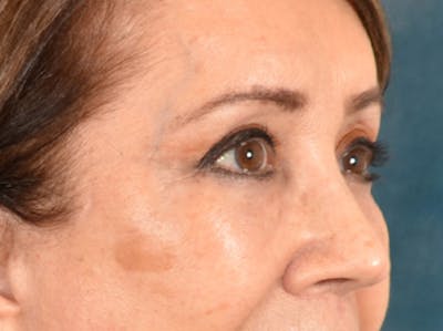 Brow Lift Before & After Gallery - Patient 109629 - Image 4