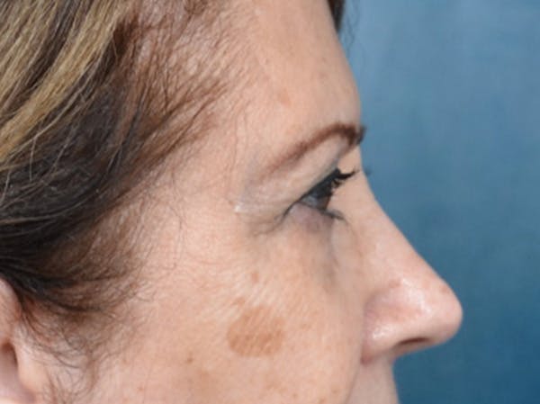 Brow Lift Before & After Gallery - Patient 109629 - Image 5
