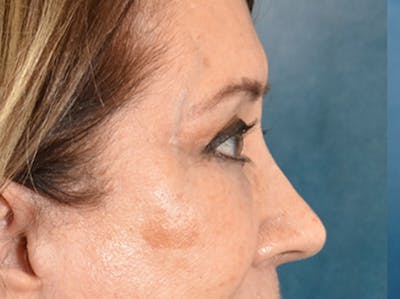 Brow Lift Before & After Gallery - Patient 109629 - Image 6