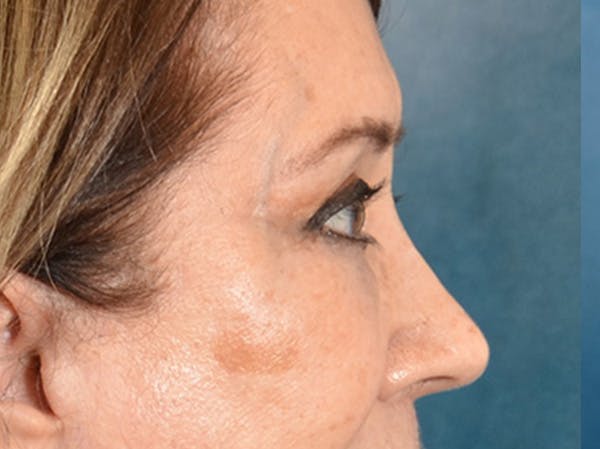 Brow Lift Before & After Gallery - Patient 109629 - Image 6