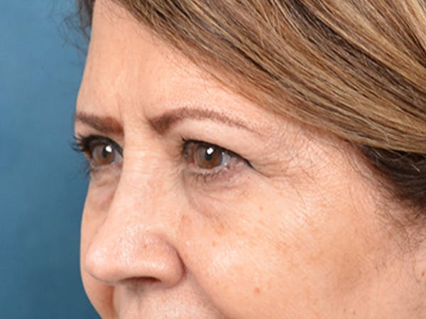 Brow Lift Before & After Gallery - Patient 109629 - Image 7