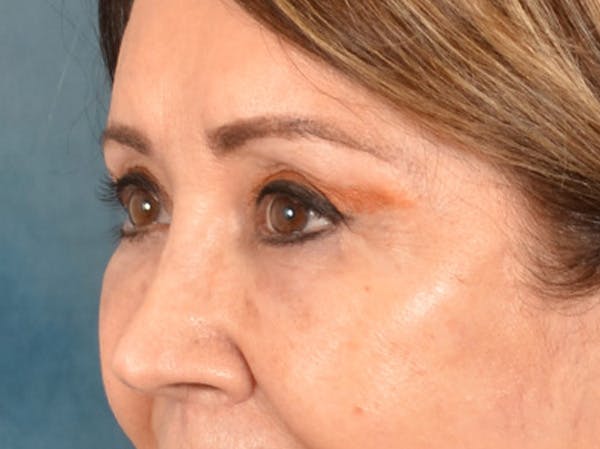 Brow Lift Before & After Gallery - Patient 109629 - Image 8