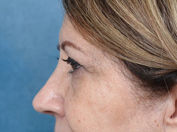 Brow Lift Before & After Gallery - Patient 109629 - Image 9