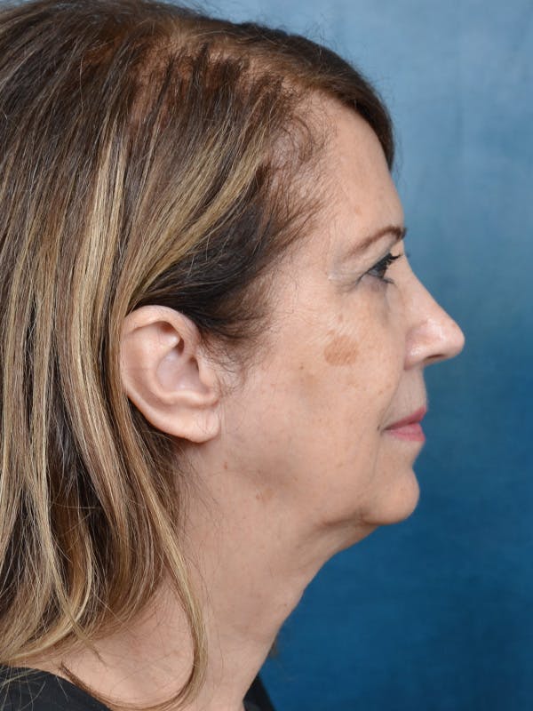 Chin Augmentation Before & After Gallery - Patient 429234 - Image 5