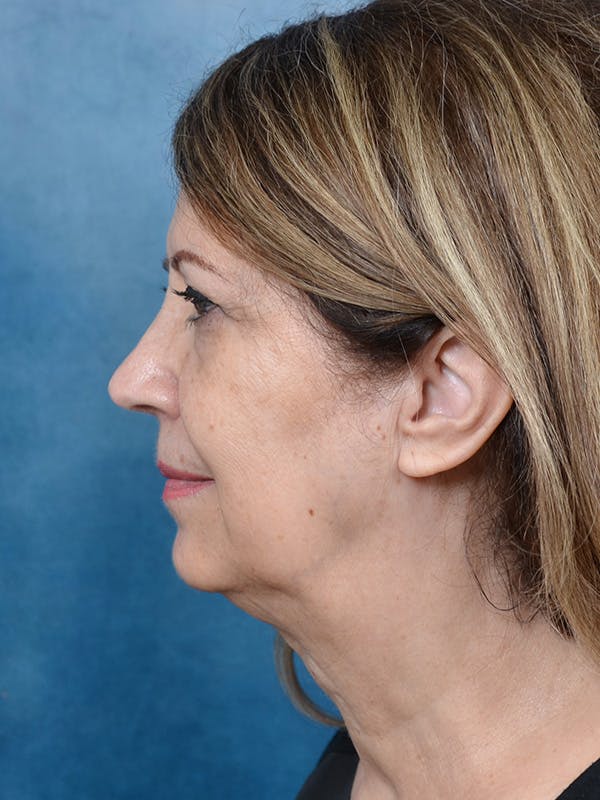 Chin Augmentation Before & After Gallery - Patient 429234 - Image 9