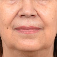 Lip Lift Before & After Gallery - Patient 172706 - Image 1