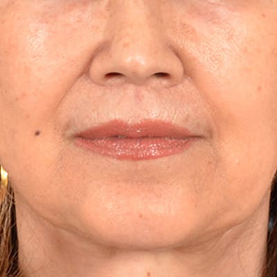 Lip Lift Before & After Gallery - Patient 172706 - Image 2