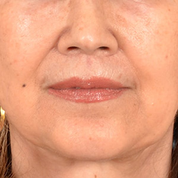 Lip Lift Before & After Gallery - Patient 172706 - Image 2