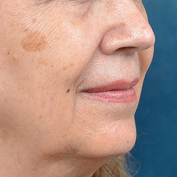 Lip Lift Before & After Gallery - Patient 172706 - Image 3