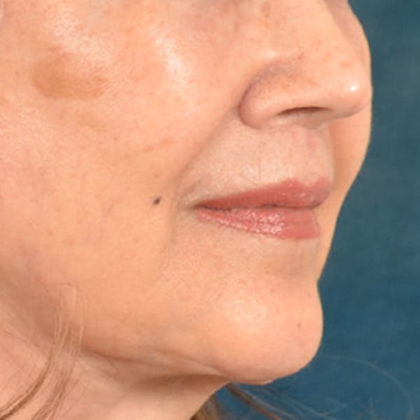 Lip Lift Before & After Gallery - Patient 172706 - Image 4