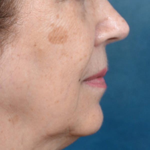 Lip Lift Before & After Gallery - Patient 172706 - Image 5