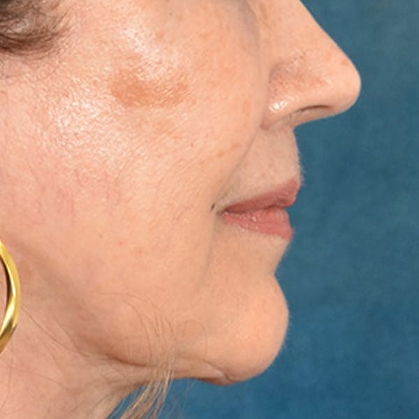 Lip Lift Before & After Gallery - Patient 172706 - Image 6