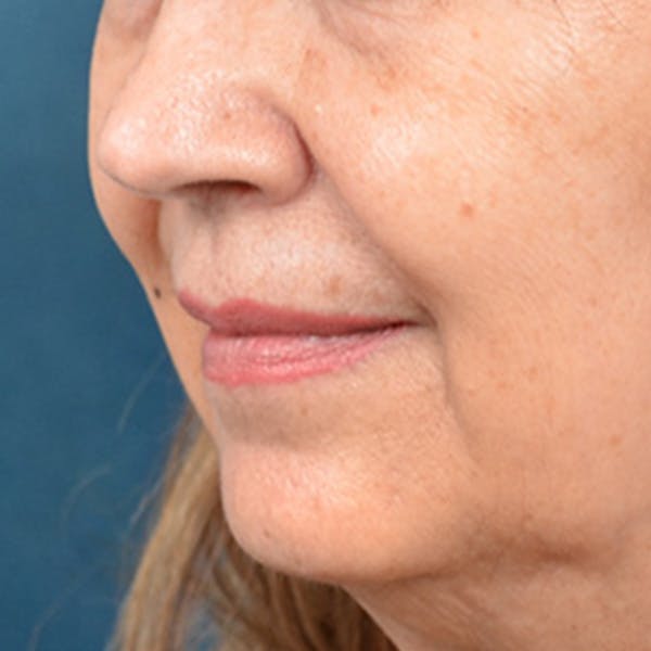 Lip Lift Before & After Gallery - Patient 172706 - Image 7