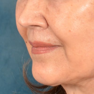 Lip Lift Before & After Gallery - Patient 172706 - Image 8