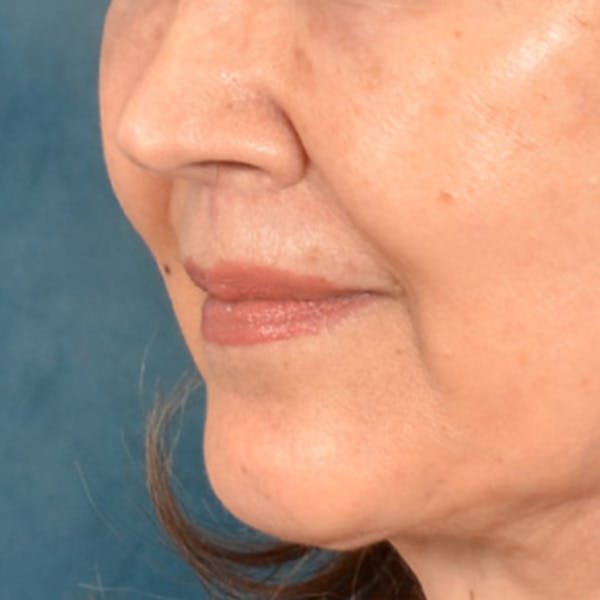 Lip Lift Before & After Gallery - Patient 172706 - Image 8