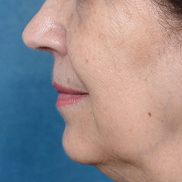 Lip Lift Before & After Gallery - Patient 172706 - Image 9