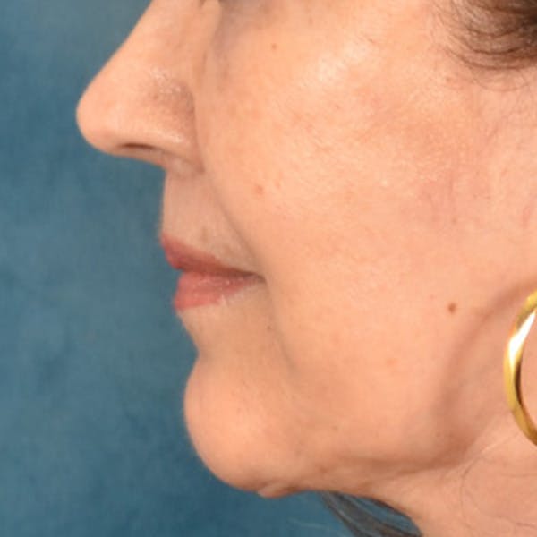 Lip Lift Before & After Gallery - Patient 172706 - Image 10