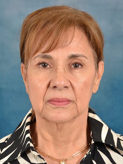 Laser Skin Resurfacing Before & After Gallery - Patient 182758 - Image 1