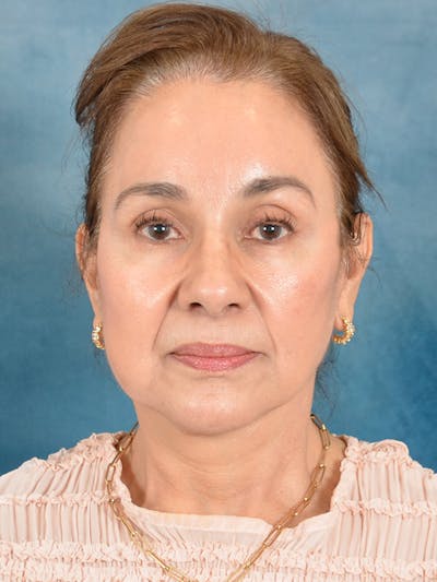 Laser Skin Resurfacing Before & After Gallery - Patient 182758 - Image 2