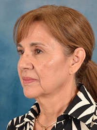 Deep Plane Facelift Before & After Gallery - Patient 399551 - Image 1