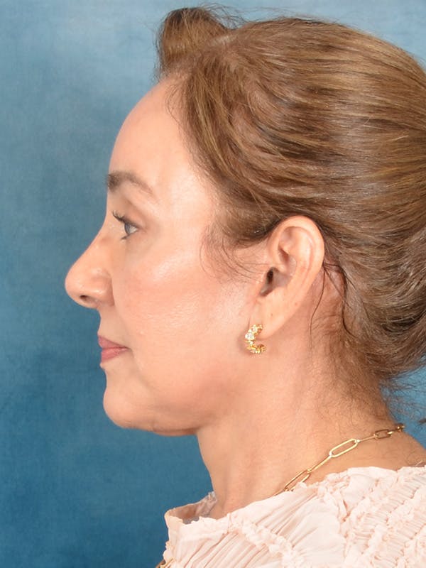 Laser Skin Resurfacing Before & After Gallery - Patient 182758 - Image 10