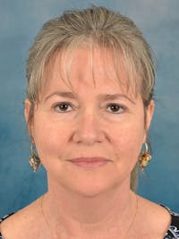 Laser Skin Resurfacing Before & After Gallery - Patient 214972 - Image 1