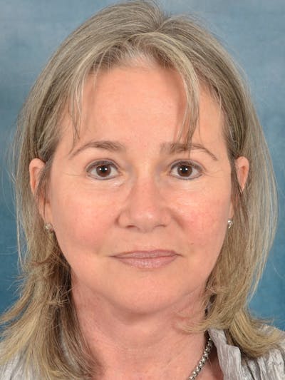 Laser Skin Resurfacing Before & After Gallery - Patient 214972 - Image 2