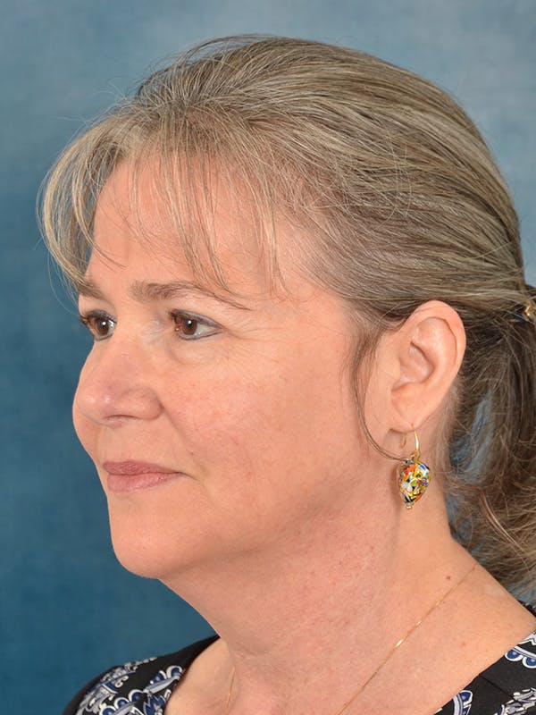 Laser Skin Resurfacing Before & After Gallery - Patient 214972 - Image 3