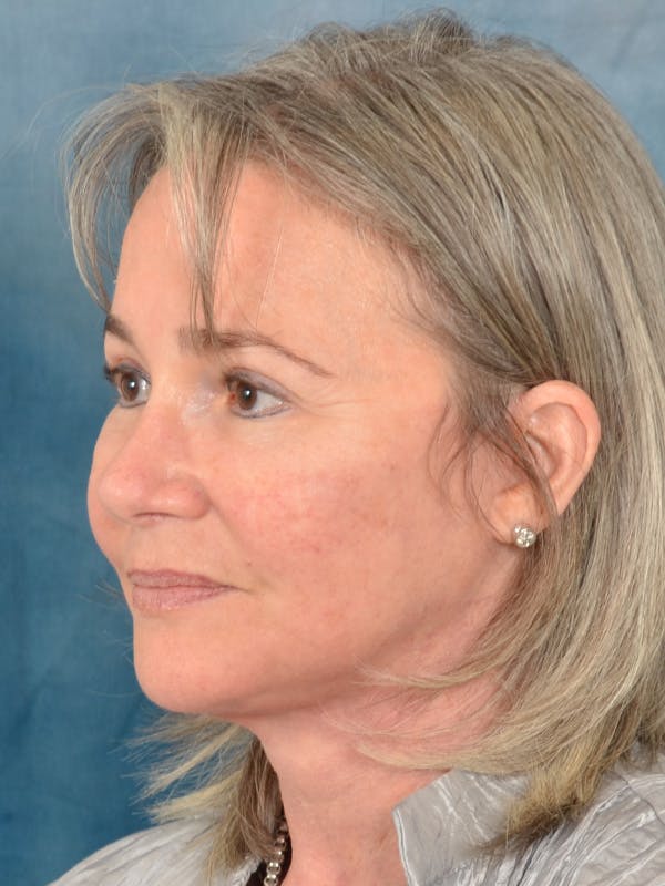 Laser Skin Resurfacing Before & After Gallery - Patient 214972 - Image 4