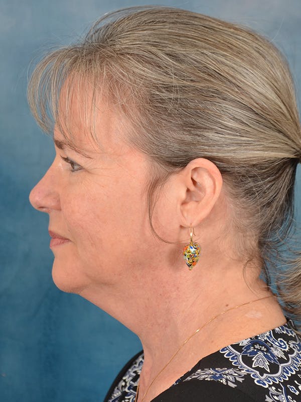 Laser Skin Resurfacing Before & After Gallery - Patient 214972 - Image 5
