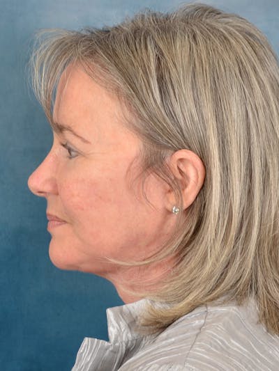 Laser Skin Resurfacing Before & After Gallery - Patient 214972 - Image 6