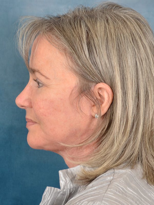 Laser Skin Resurfacing Before & After Gallery - Patient 214972 - Image 6