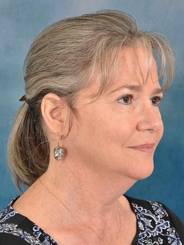 Laser Skin Resurfacing Before & After Gallery - Patient 214972 - Image 7
