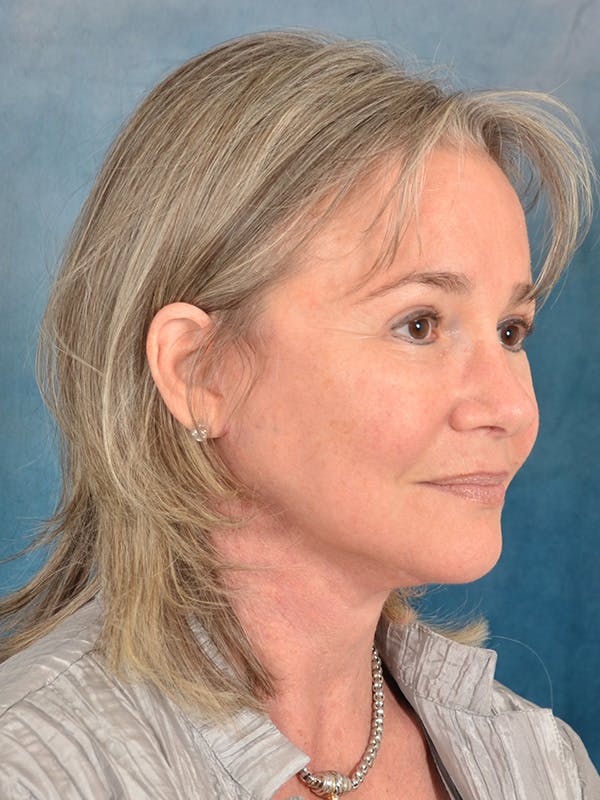 Laser Skin Resurfacing Before & After Gallery - Patient 214972 - Image 8