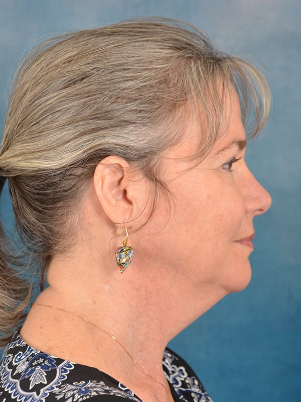 Laser Skin Resurfacing Before & After Gallery - Patient 214972 - Image 9