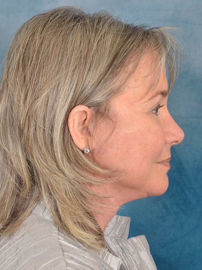 Laser Skin Resurfacing Before & After Gallery - Patient 214972 - Image 10