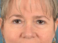 Brow Lift Before & After Gallery - Patient 197310 - Image 1