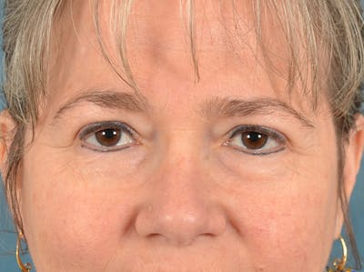 Brow Lift Before & After Gallery - Patient 197310 - Image 1
