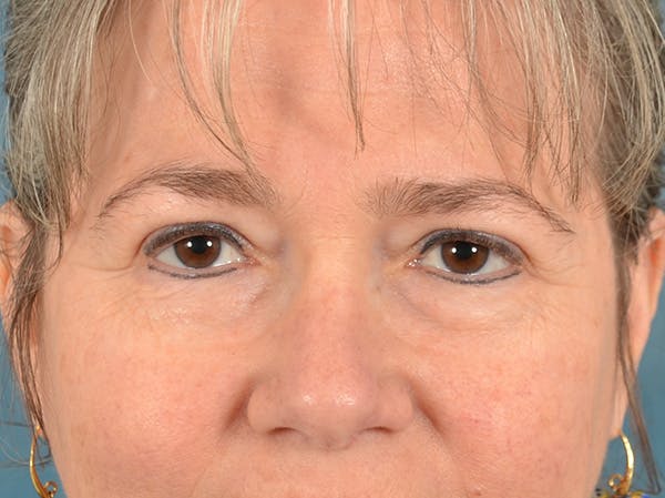 Brow Lift Before & After Gallery - Patient 197310 - Image 1