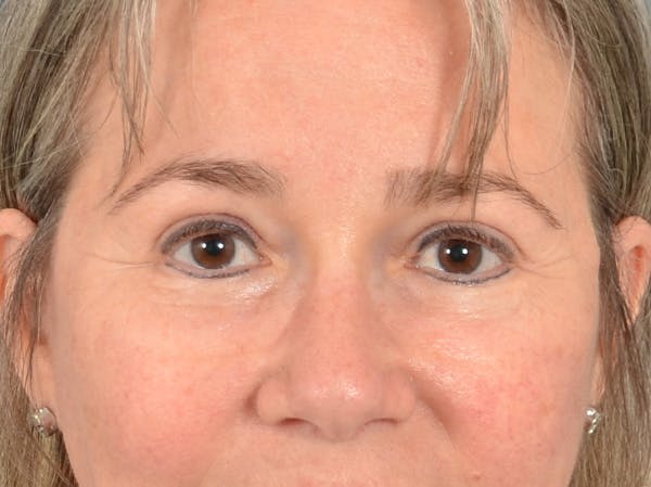 Brow Lift Before & After Gallery - Patient 197310 - Image 2