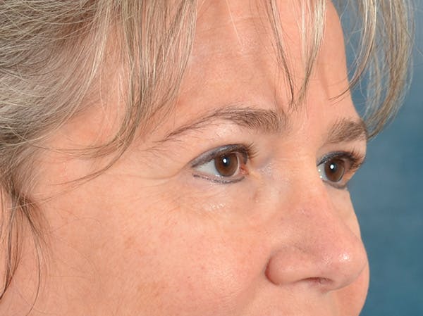 Brow Lift Before & After Gallery - Patient 197310 - Image 3
