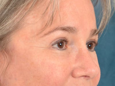 Brow Lift Before & After Gallery - Patient 197310 - Image 4