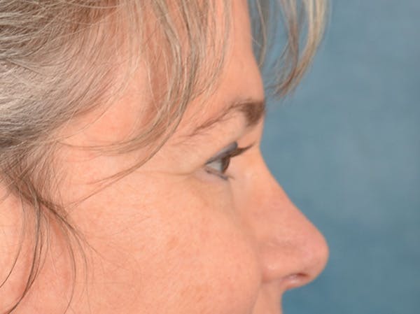 Brow Lift Before & After Gallery - Patient 197310 - Image 5