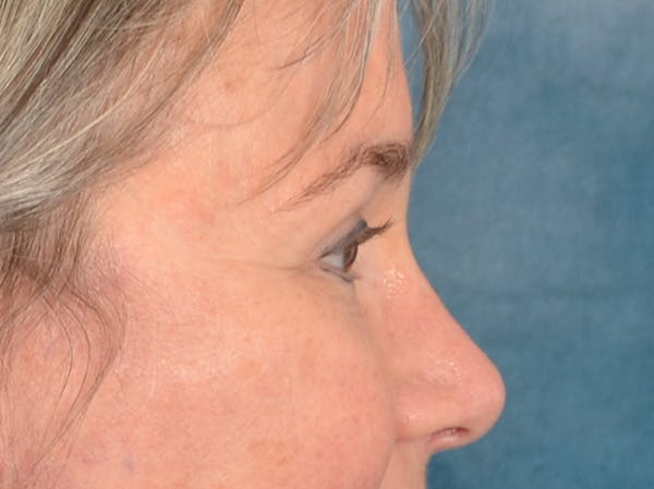 Brow Lift Before & After Gallery - Patient 197310 - Image 6